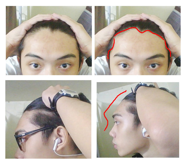 I DON'T KNOW WHAT TYPE OF HAIRSTYLE SUITS ME CAUSE OF MY WEIRD HAIRLINE |  Styleforum